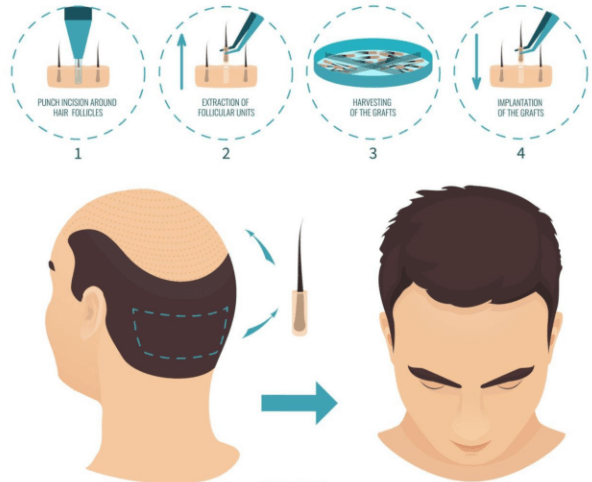 hair transplant singapore