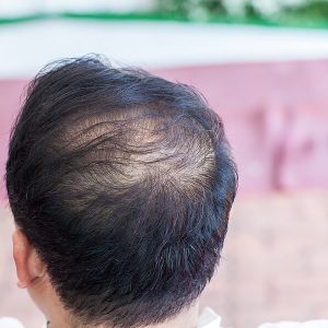 bigstock-Close-Up-Hair-Loss-Thinning-H-366610480