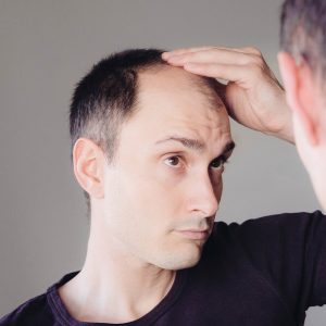 bigstock-Male-Pattern-Hair-Loss-Problem-402236954