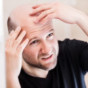 bigstock-Male-alopecia-or-hair-loss-con-238538227